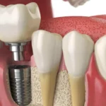 Risks and Complications of Dental Implants
