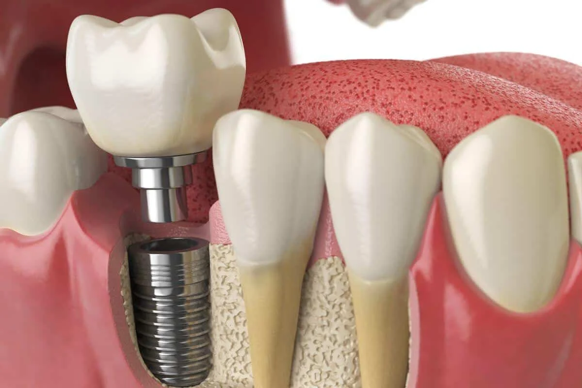 Risks and Complications of Dental Implants