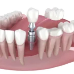 Dental Implants vs Veneers