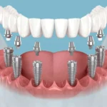 Secure Implant Supported Teeth