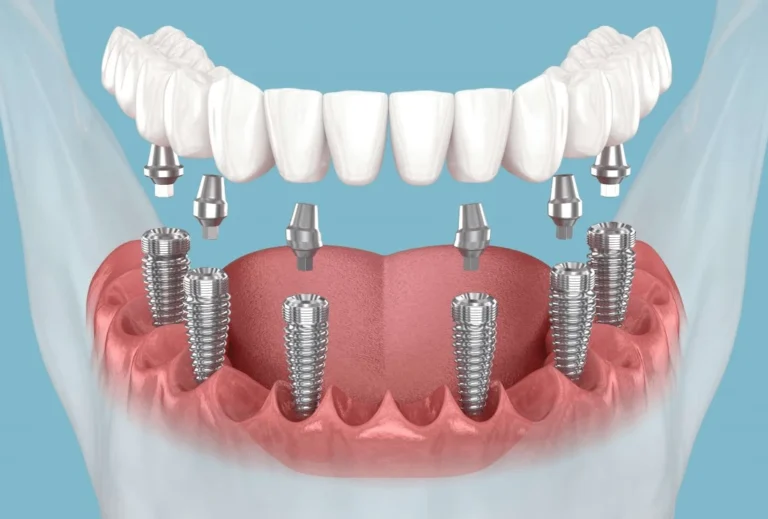 Secure Implant Supported Teeth for Better Comfort 
