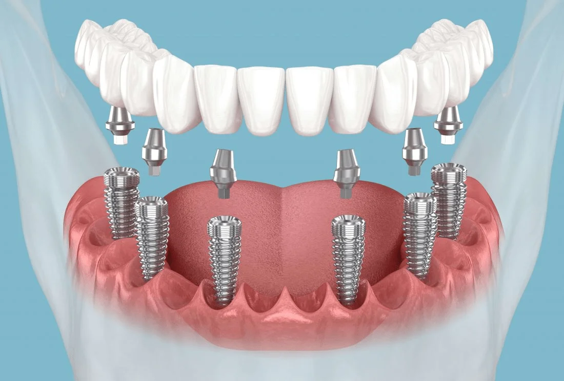 Secure Implant Supported Teeth