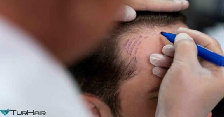 Surgeon Performed Hair Transplant Turkey