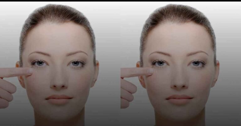 Blepharoplasty