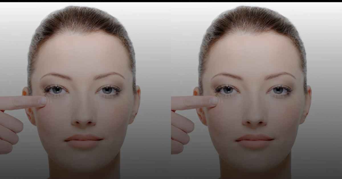 Blepharoplasty